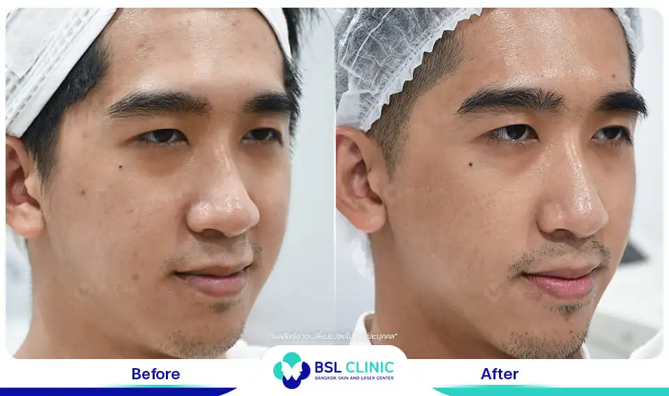 รักษาหน้าหมองคล้ำ