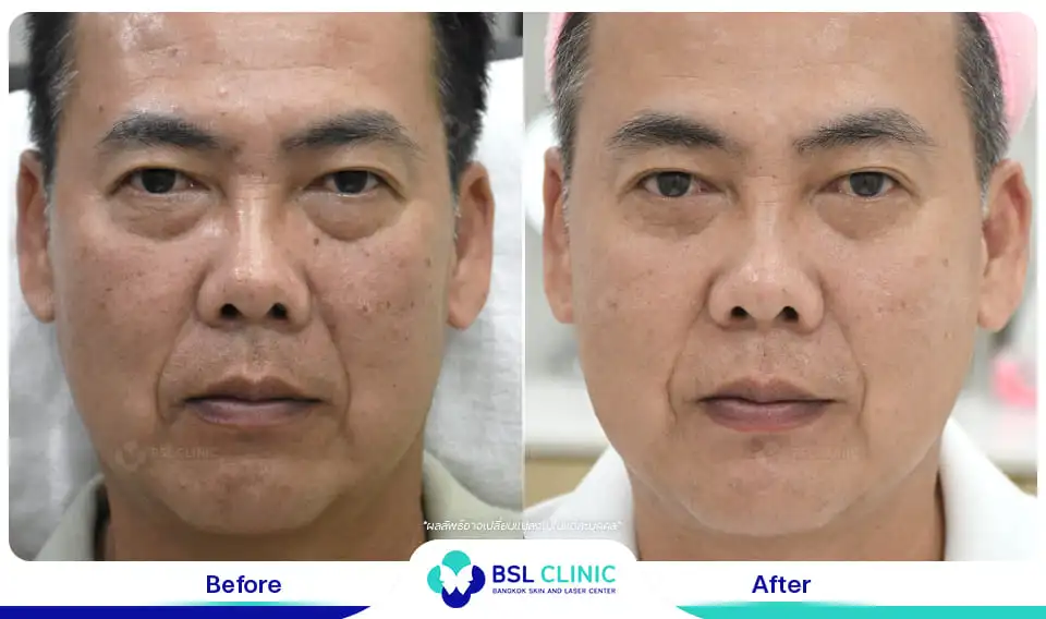 รักษาหน้าหมองคล้ำ