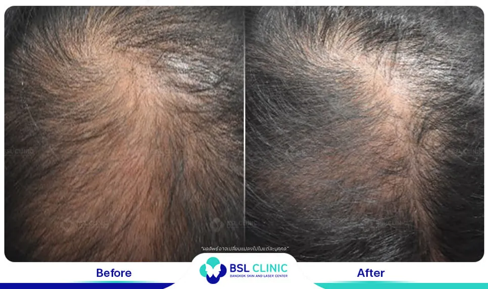 รักษาผมบาง