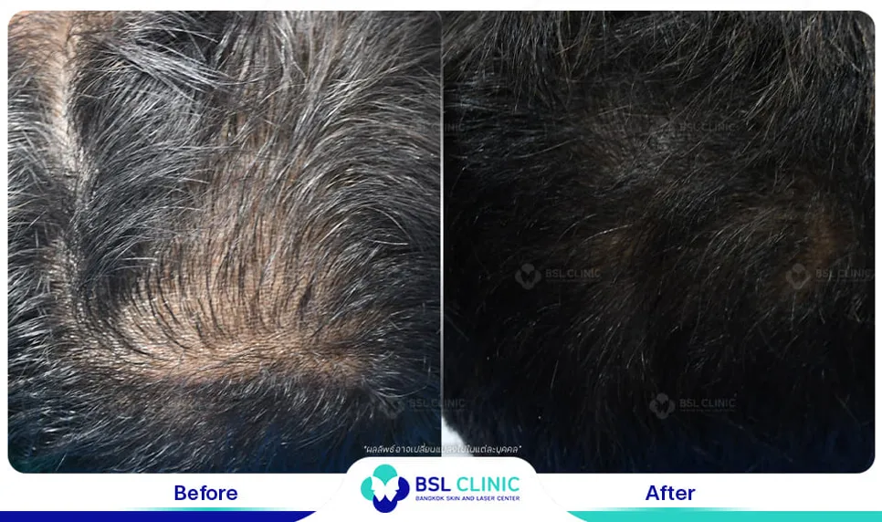 รักษาผมบาง