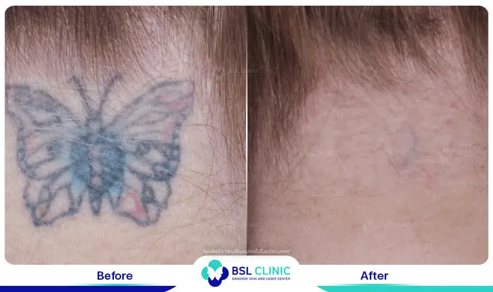 result รอยสัก