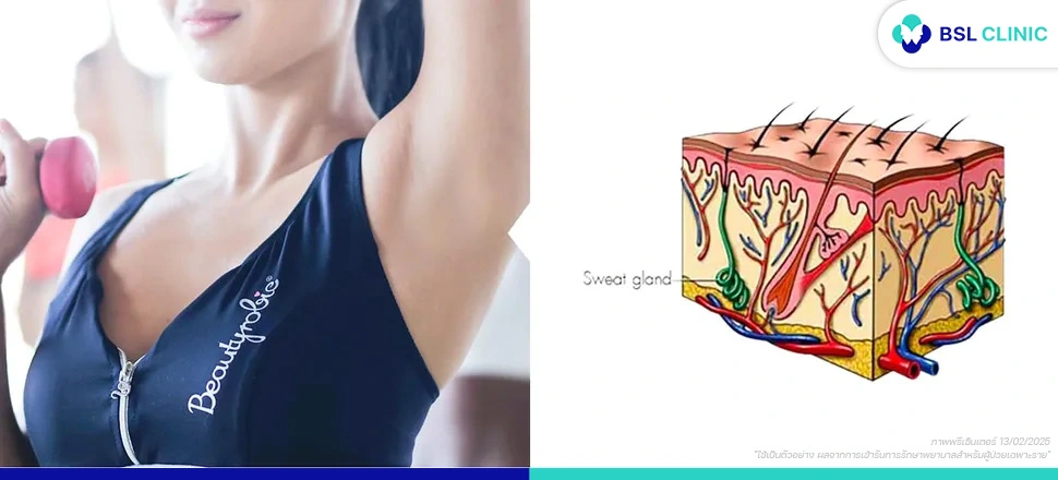 ภาวะที่มีเหงื่อออกมากผิดปกติ (Hyperhidrosis)
