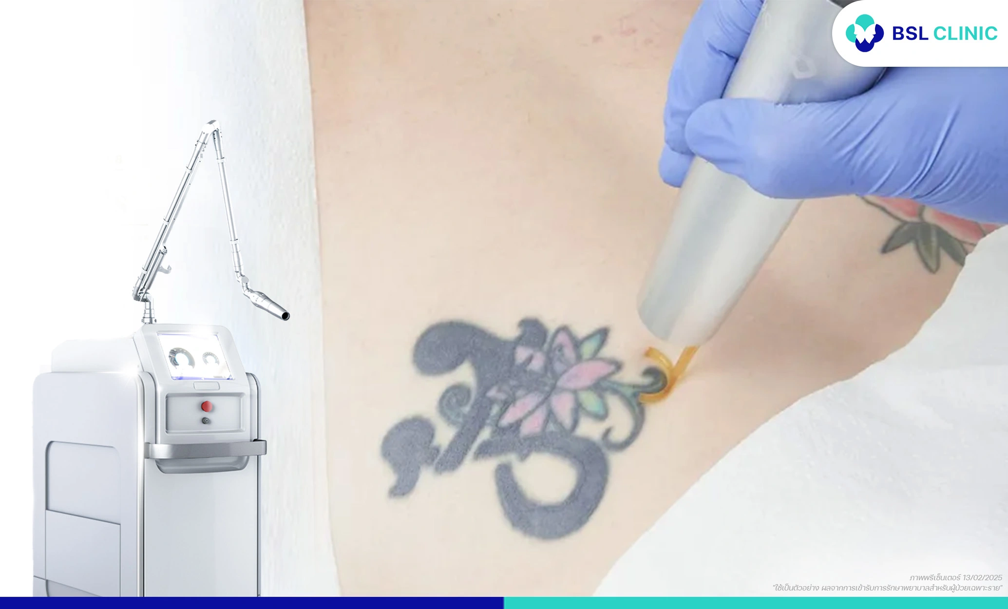 ลบรอยสัก