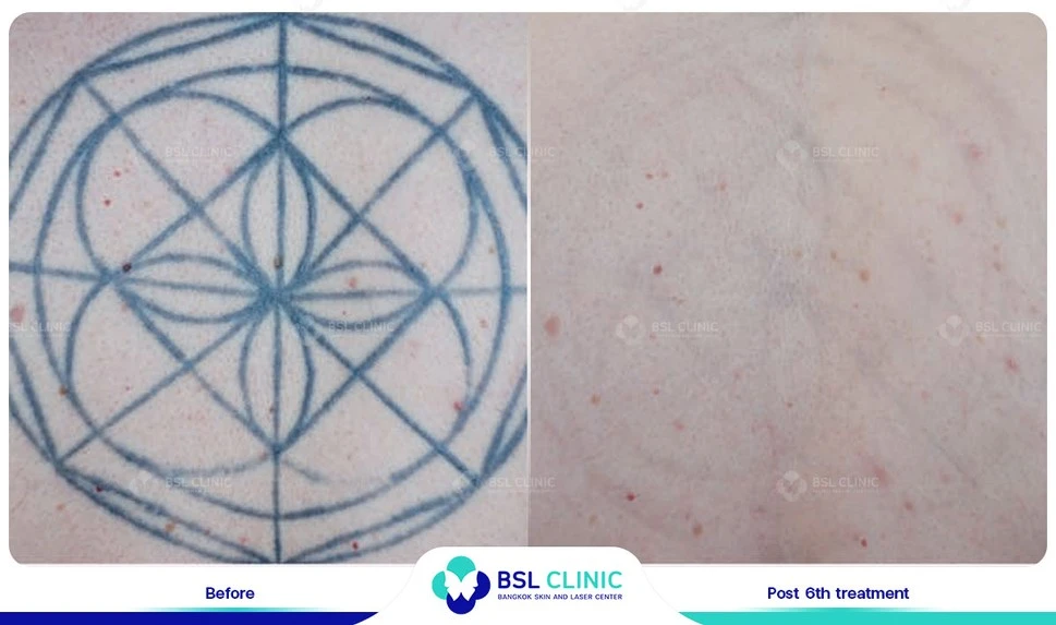 ลบรอยสัก