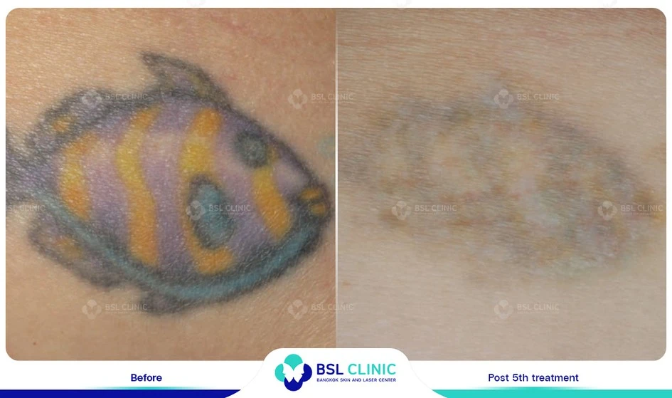 ผลลัพธ์รีวิวลบรอยสัก