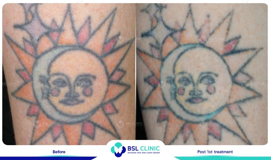 รอยสักจางลง