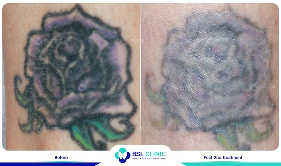 รอยสักจางลง