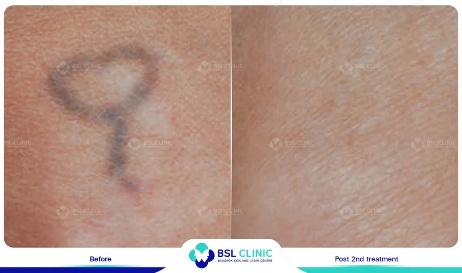 เลเซอร์ลบรอยสัก