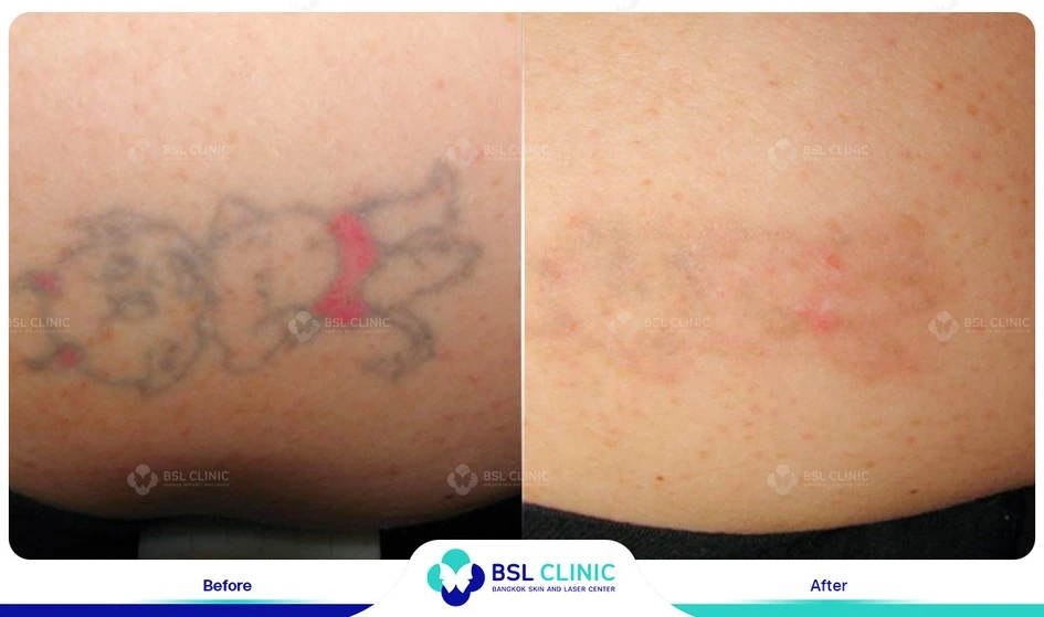 เลเซอร์ลบรอยสัก