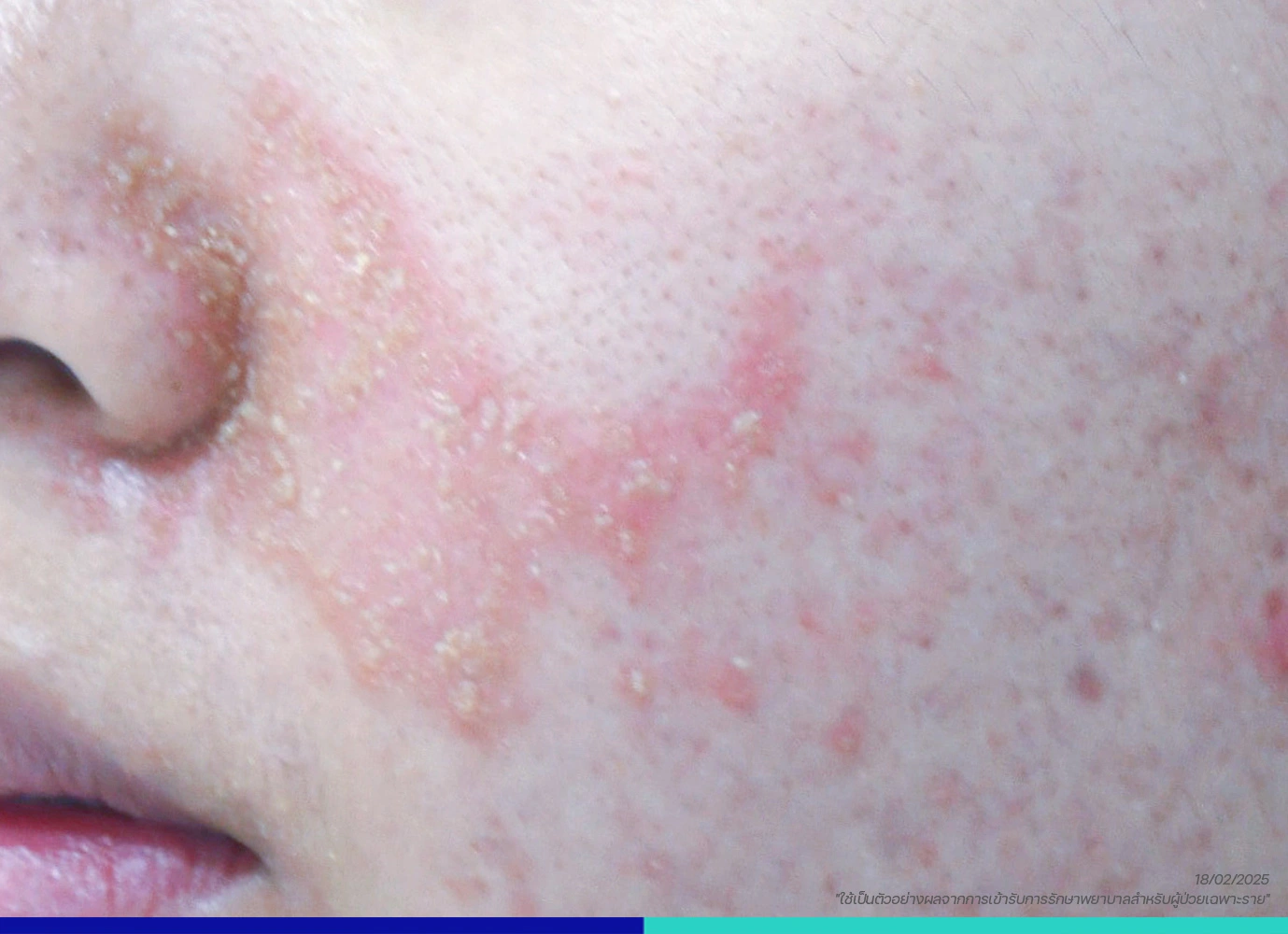 โรคเซ็บเดิร์ม