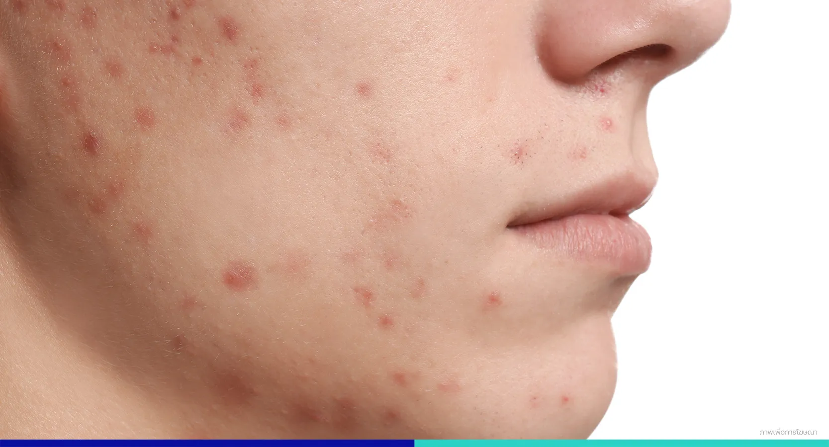 รักษาสิวอุดตัน