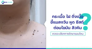 CO2 เลเซอร์