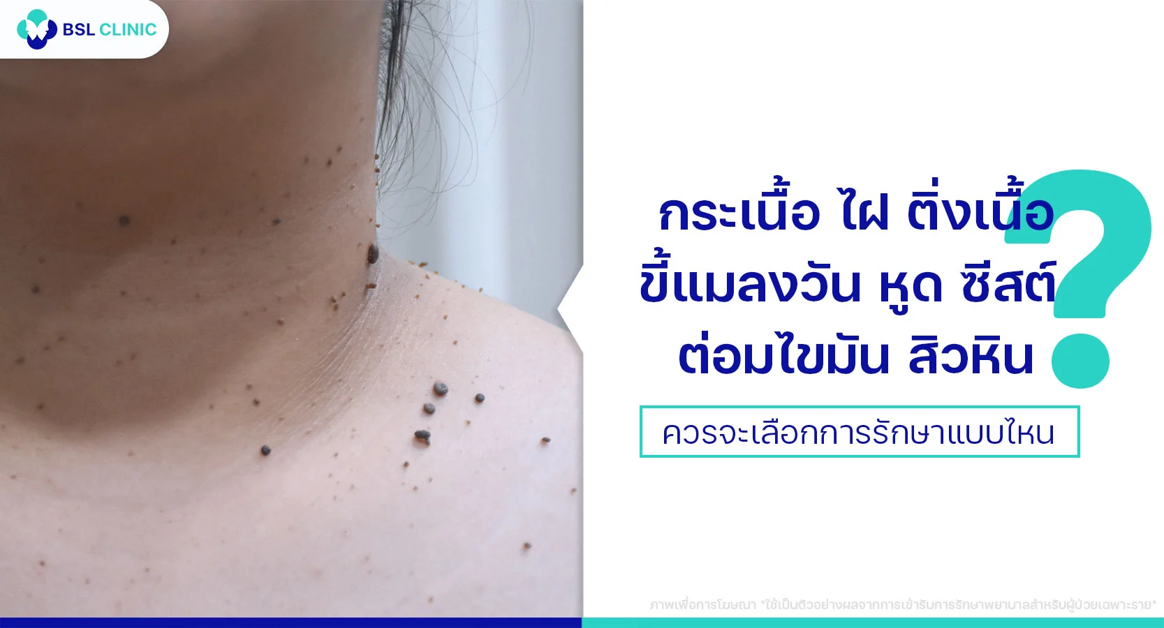 CO2 เลเซอร์