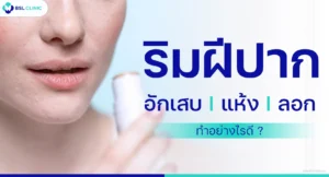 ริมฝีปากอักเสบ