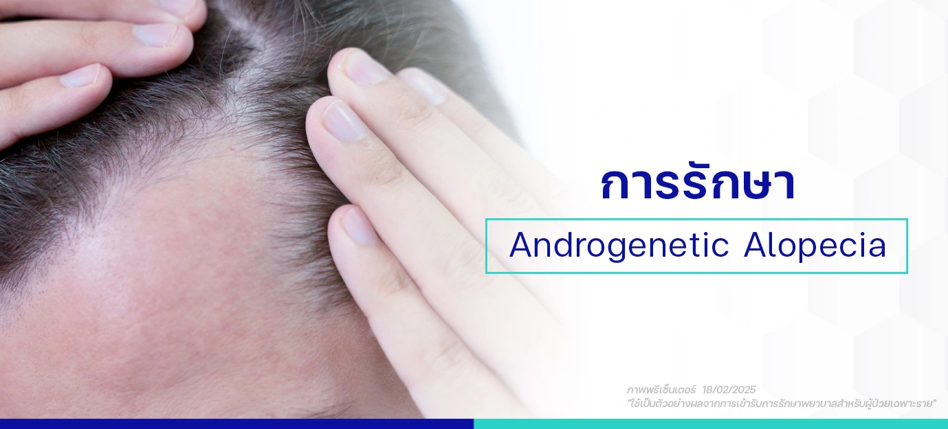 การรักษาผมร่วงจากพันธุกรรมและฮอร์โมนเพศชาย