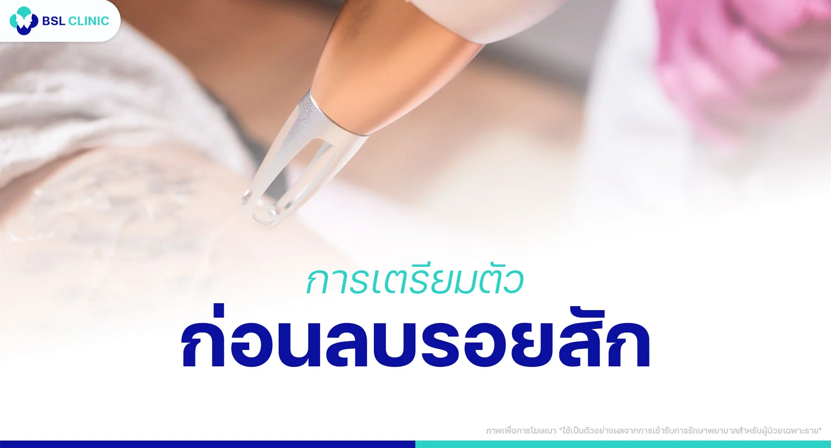 ลบรอยสักด้วย PicoWay Program