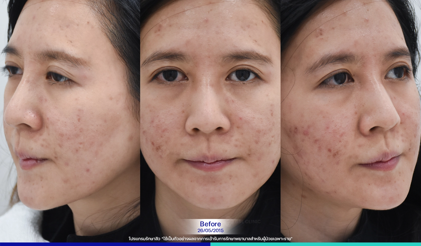 รีวิว BSL รักษาสิวดีไหม