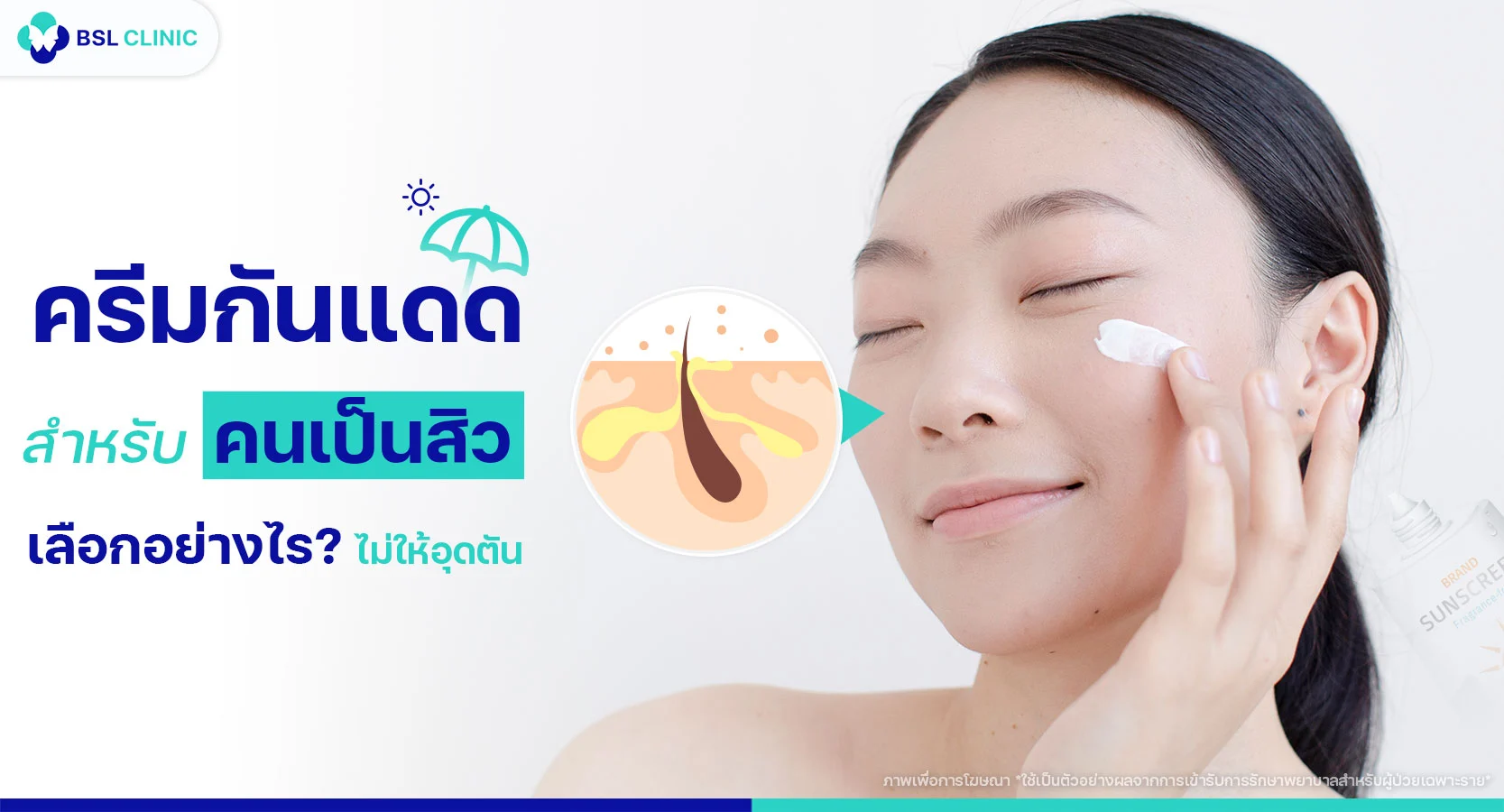 ครีมกันแดดสำหรับคนเป็นสิว