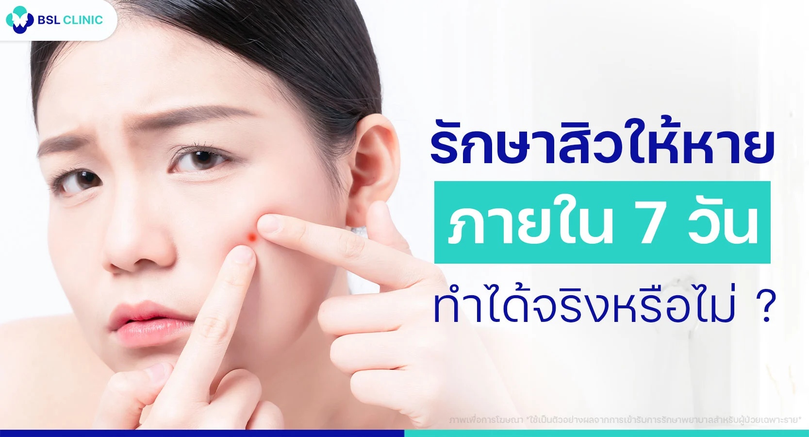 คลินิกรักษาสิวที่ไหนดี