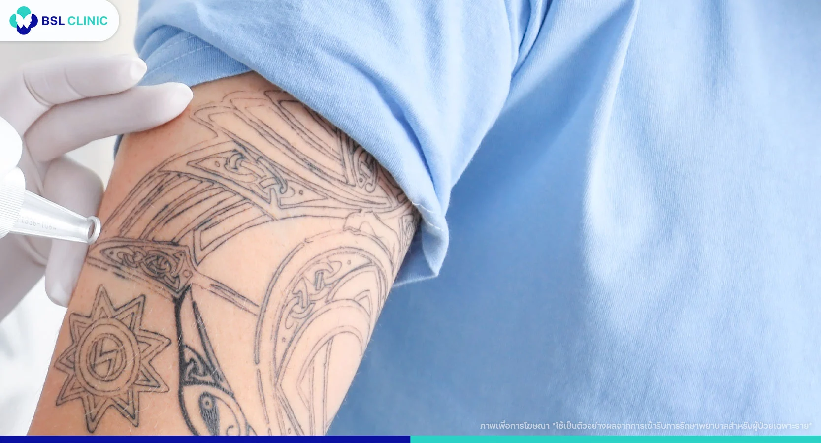 ลบรอยสักที่ไหนดี