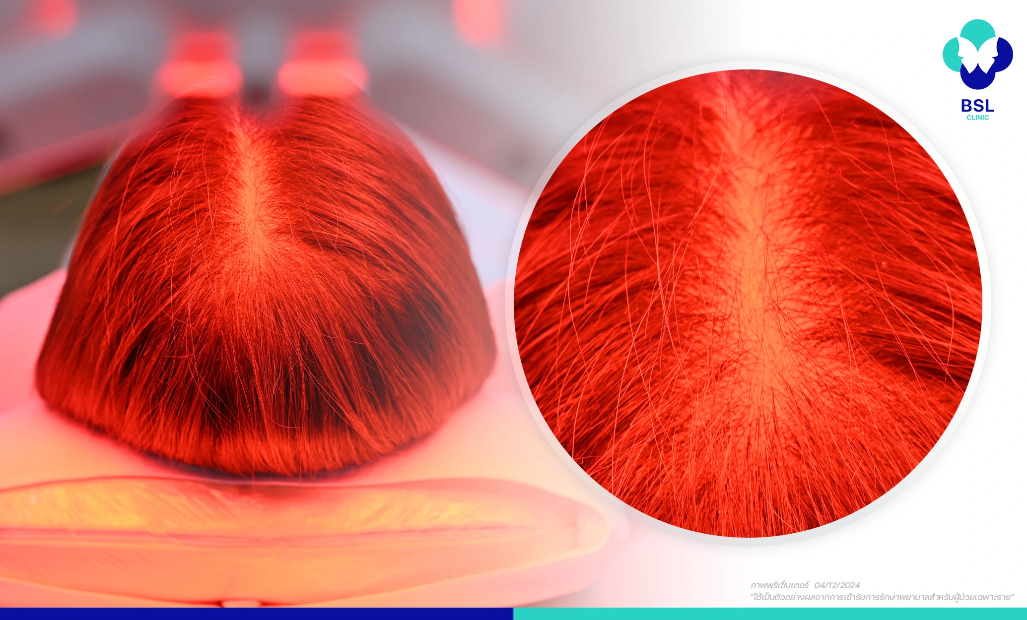 ข้อดีของการรักษาผมร่วงด้วย Laser Hair Regrowth Program