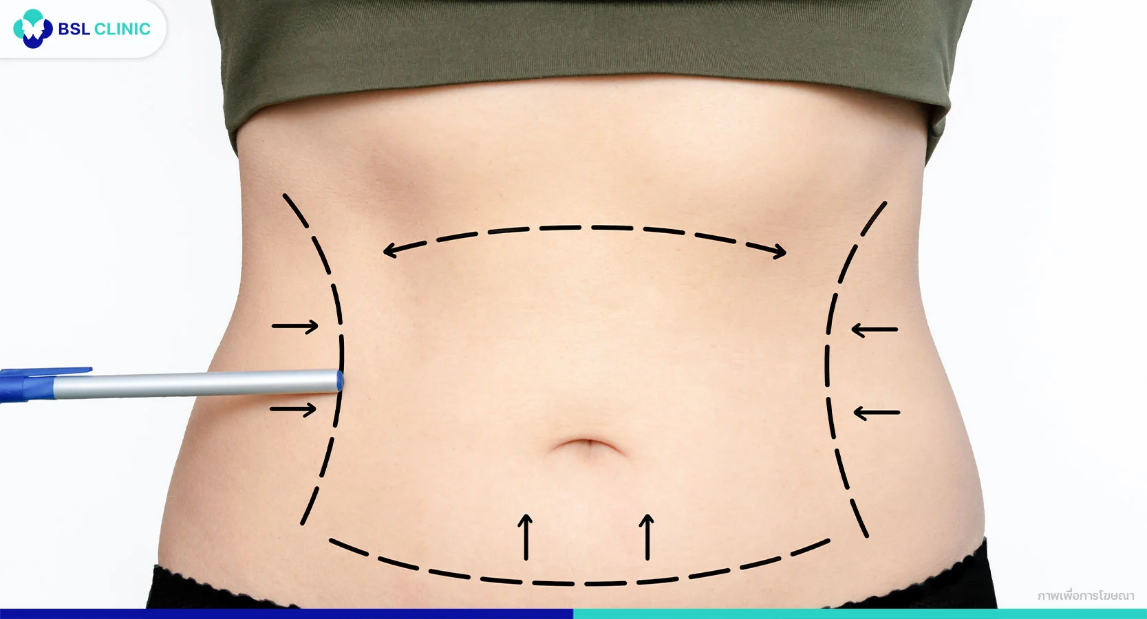 ดูดไขมัน ความรู้สึกระหว่างทำเป็นอย่างไร?
