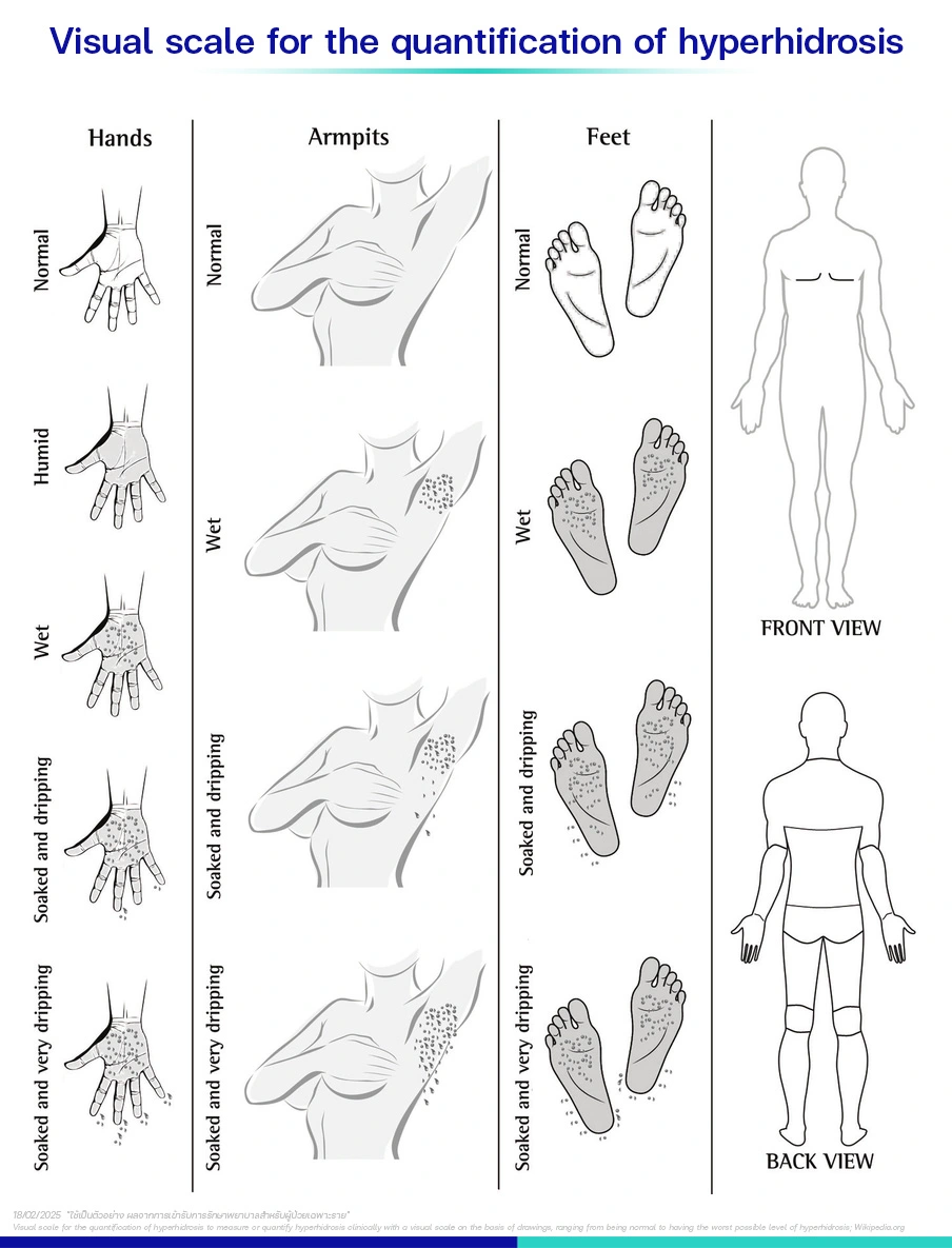 เหงื่อออกมากเกินไป