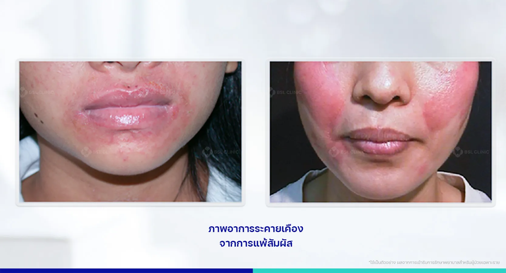 แพ้เครื่องสำอาง