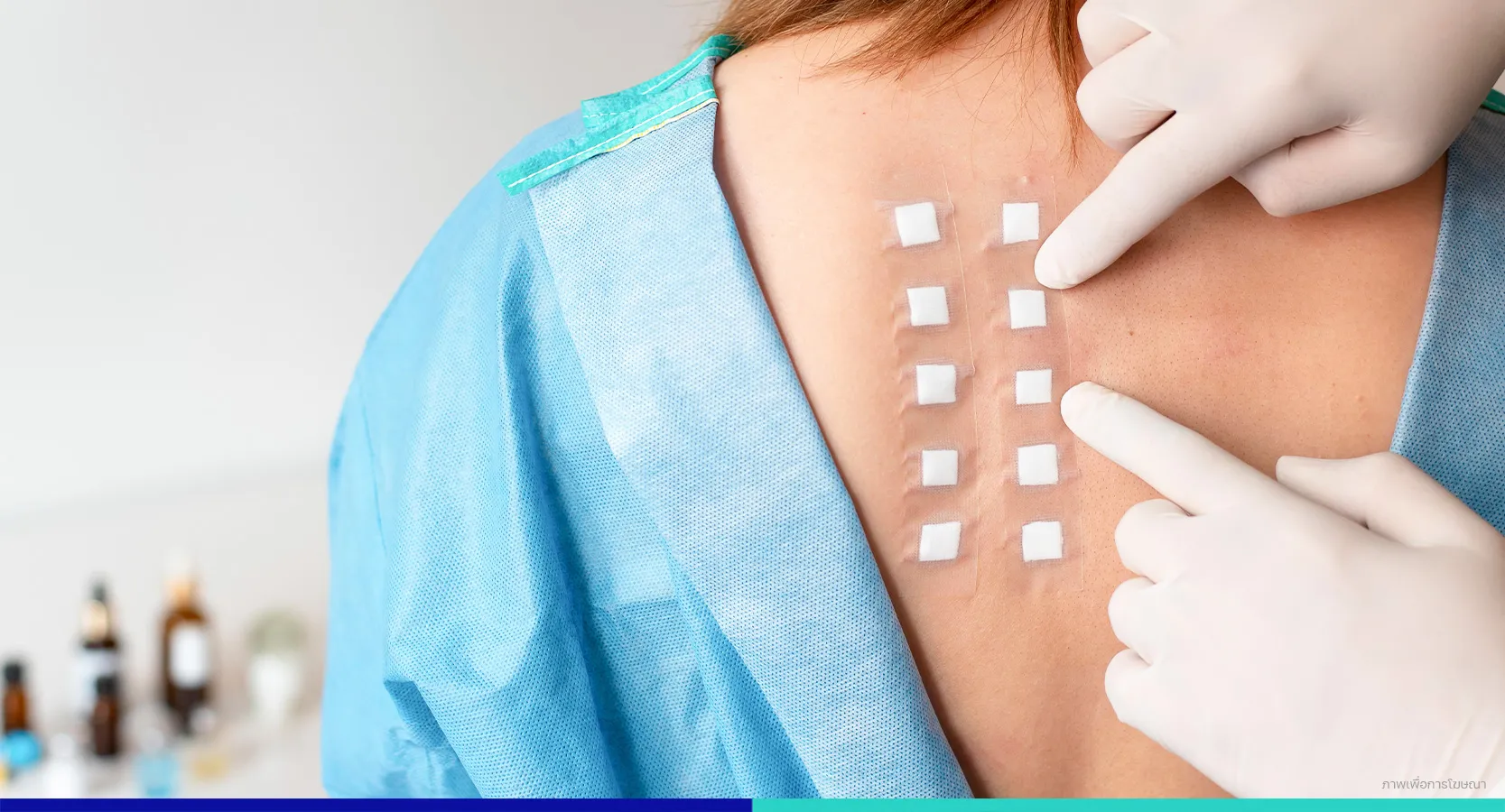 อาการแพ้ผิวหนัง