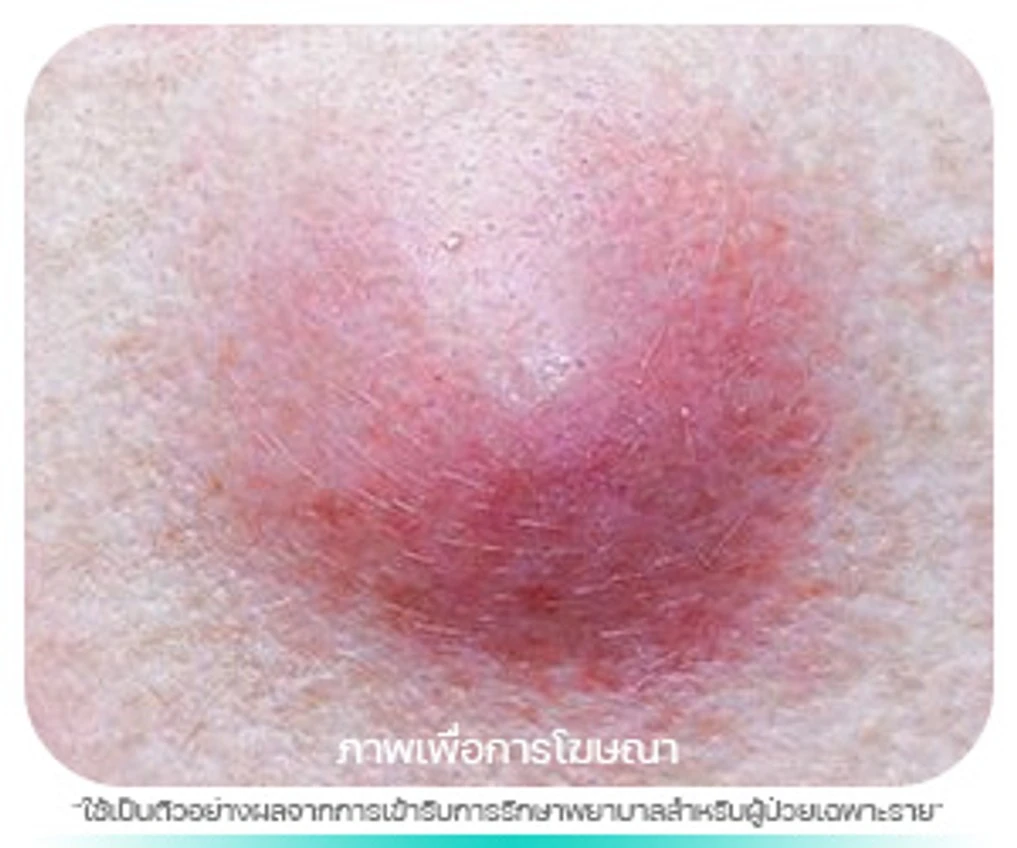 ซีสต์ (Epidermal Inclusion Cyst)