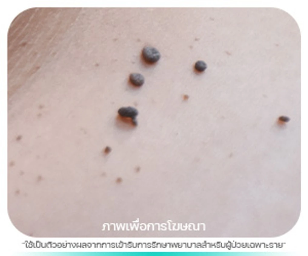 ติ่งเนื้อ