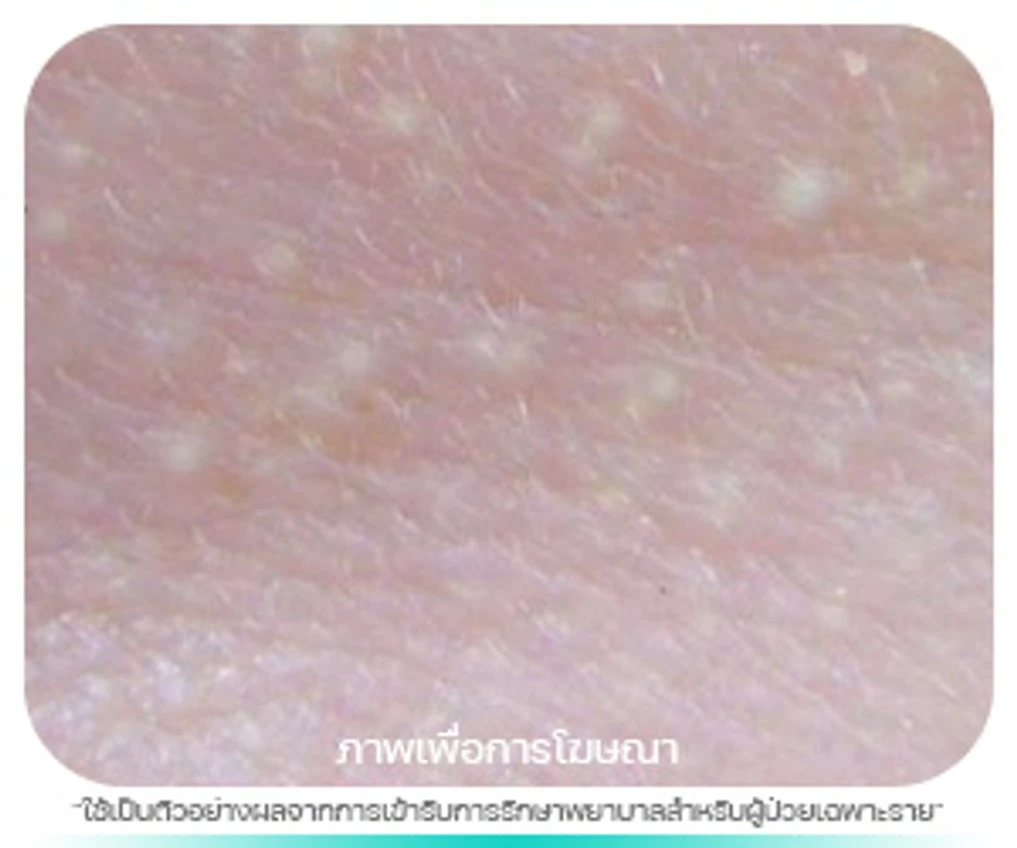 สิวหิน (Milia)