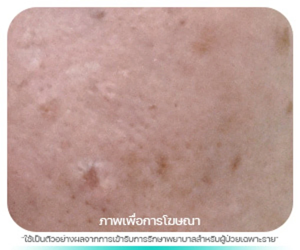 เนื้องอกต่อมไขมัน (Sebaceous Gland Hyperplasia)