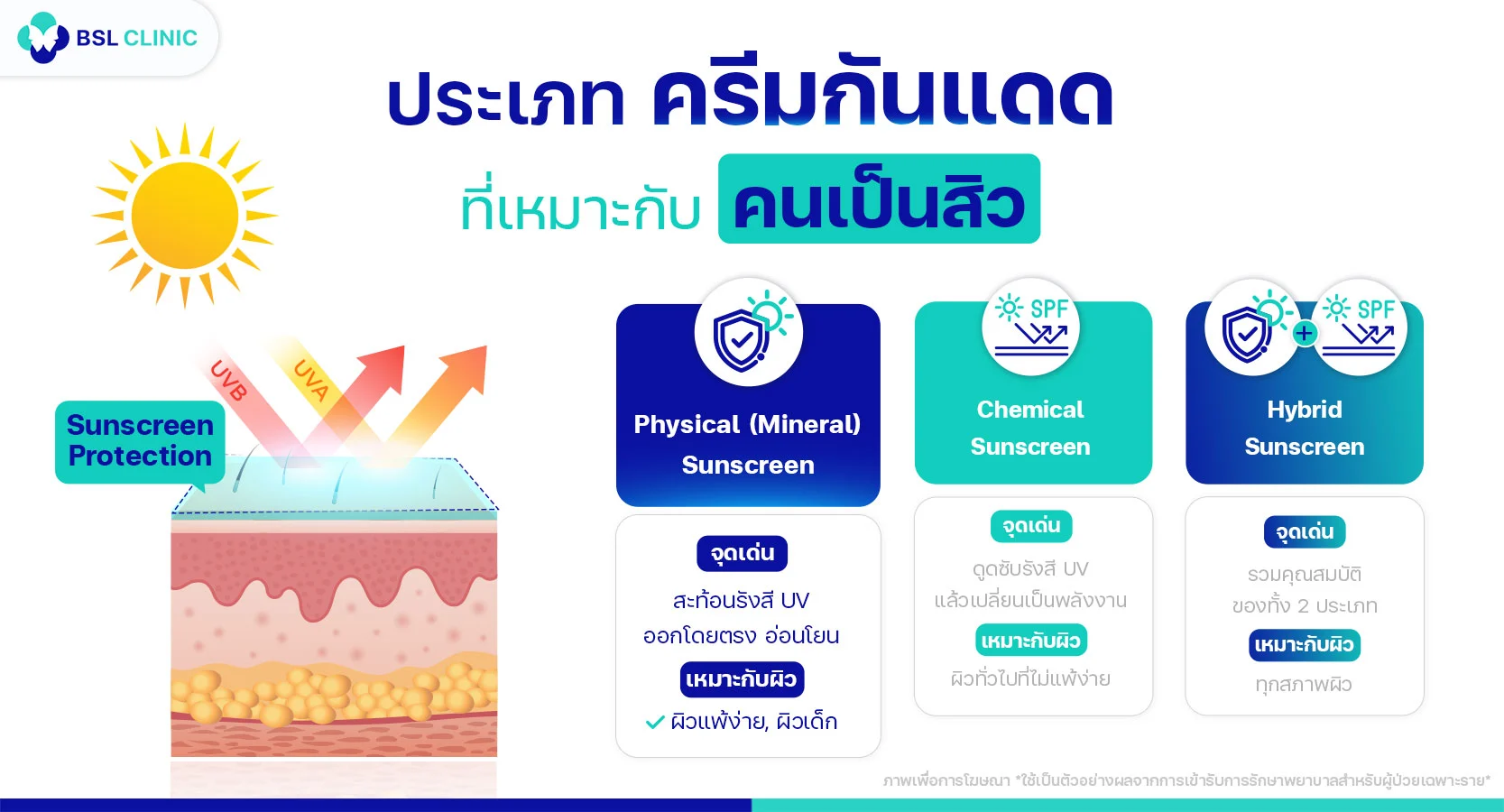 ครีมกันแดดสำหรับคนเป็นสิว