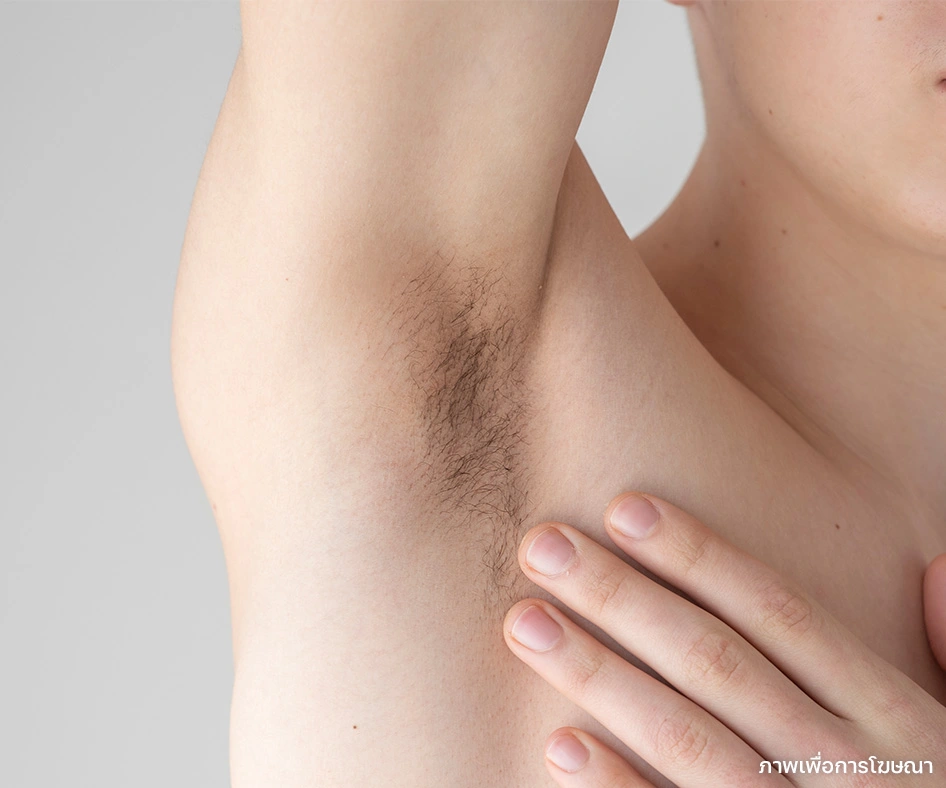 เลเซอร์ขนรักแร้