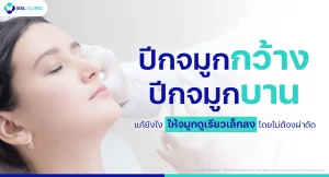 ปีกจมูกกว้าง แก้ยังไง