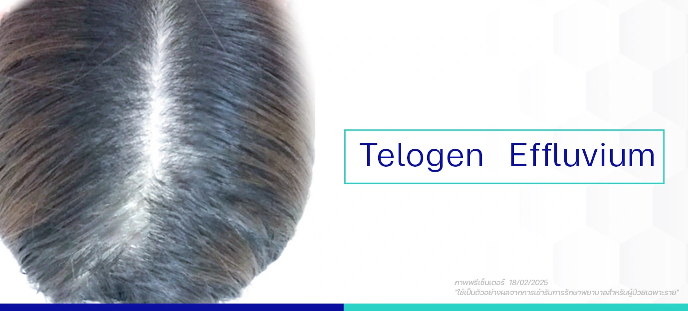 สาเหตุหลัก Telogen Effluvium
