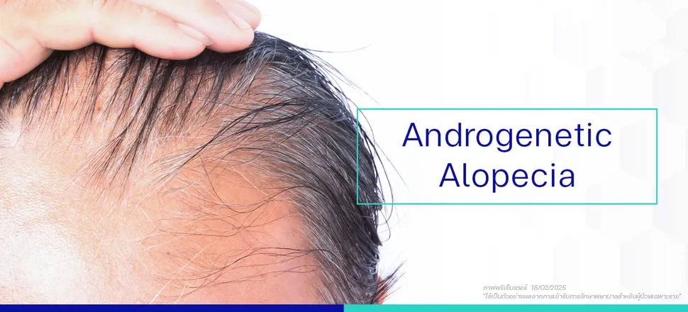 สาเหตุหลัก Androgenetic Alopecia