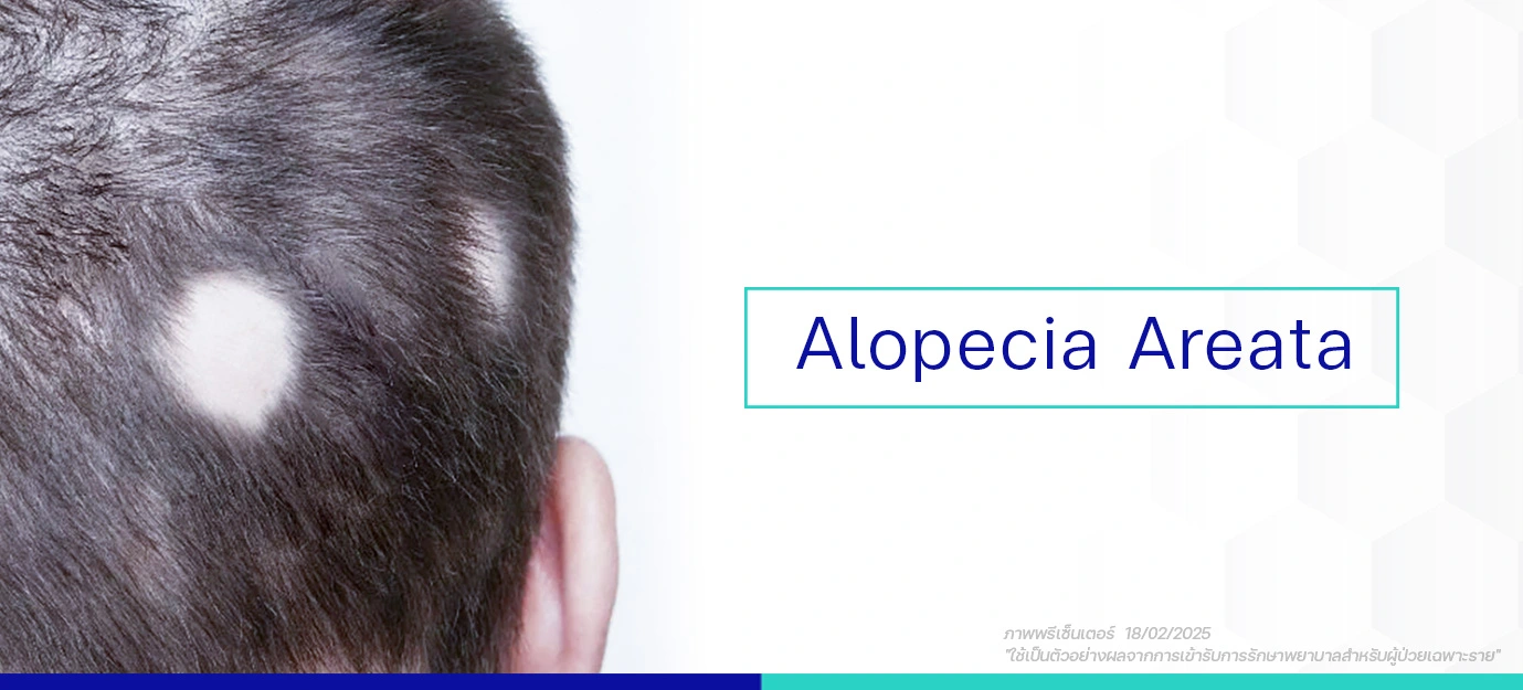 สาเหตุหลัก Alopecia Areata