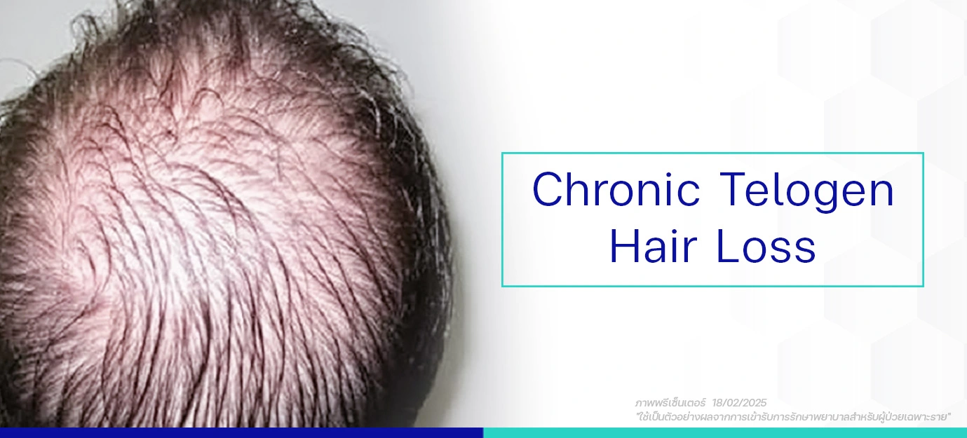 สาเหตุหลัก Chronic Telogen Hair Loss