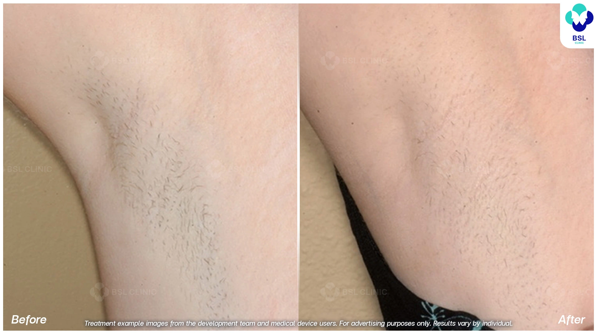 รักแร้เนียน