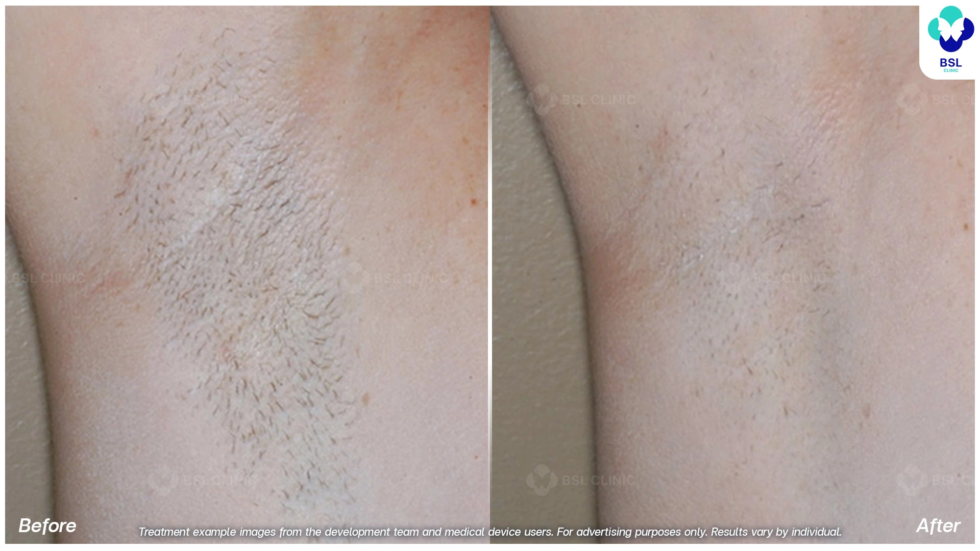 เลเซอร์กำจัดขน