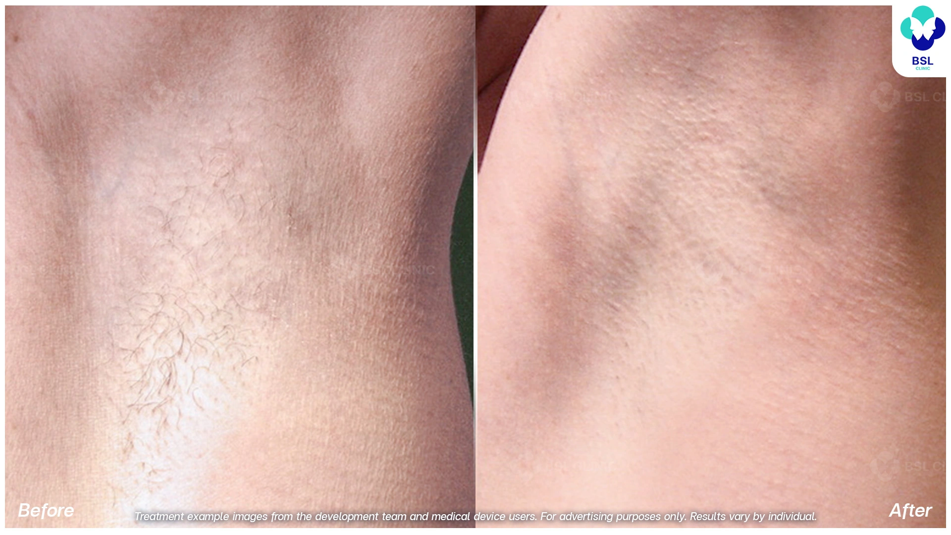 รีวิวรักแร้เนียน