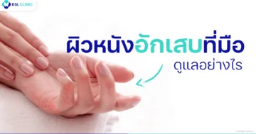 ผิวหนังอักเสบที่มือ