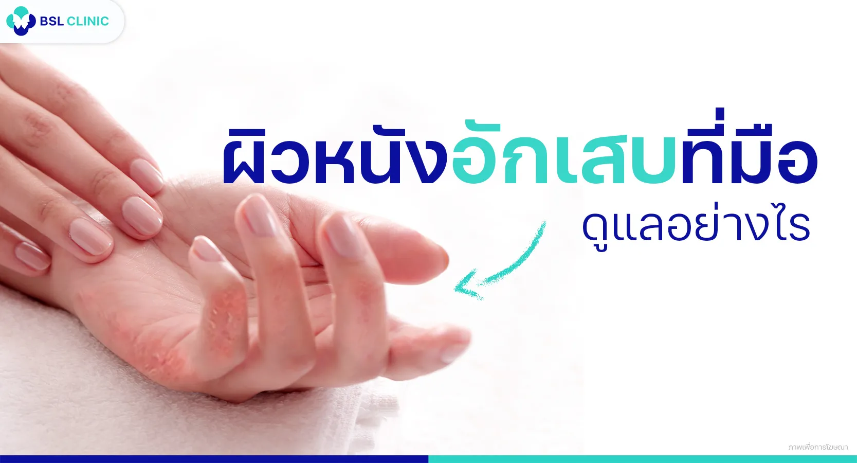 ผิวหนังอักเสบที่มือ