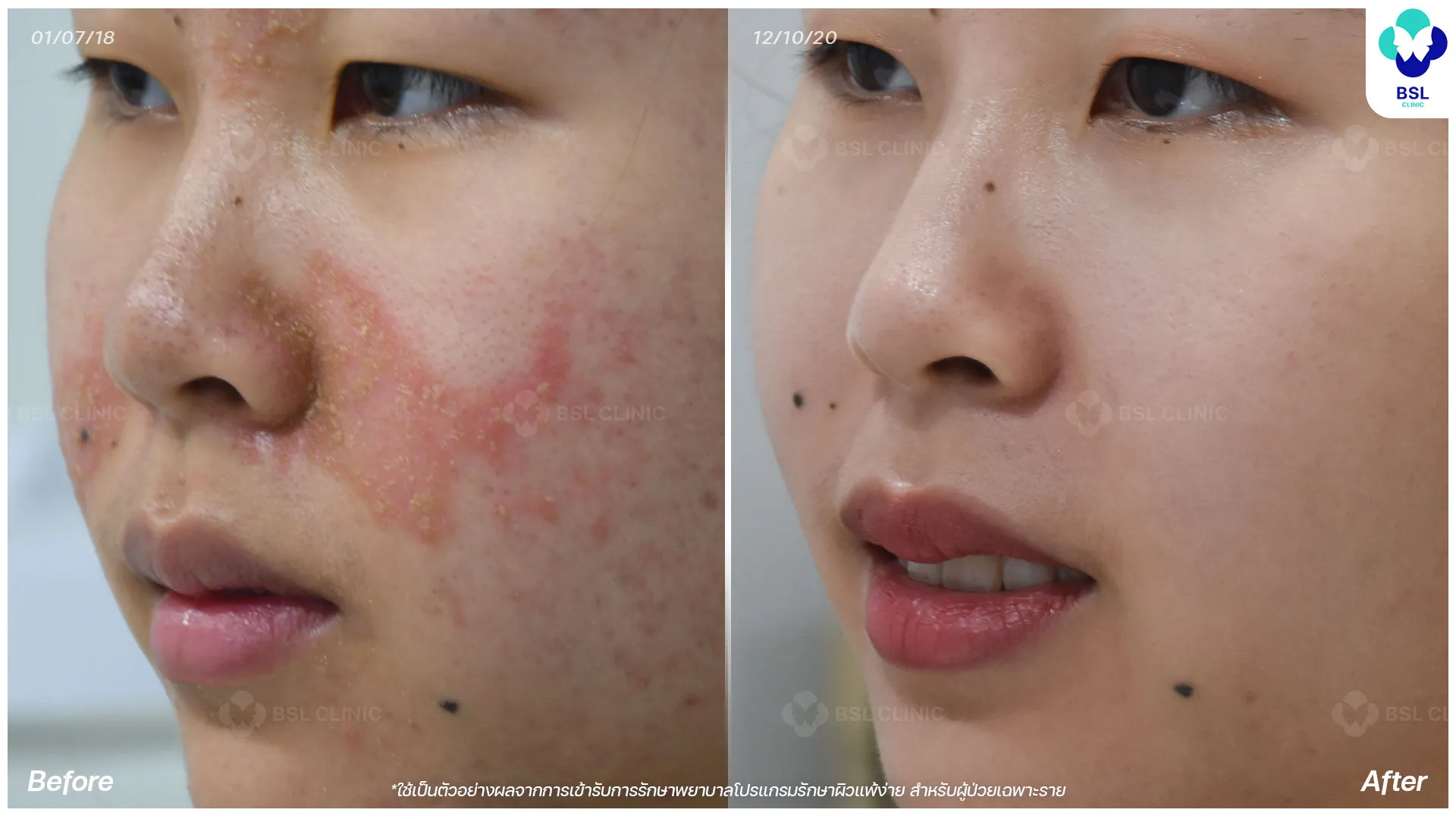 ผื่นคัน