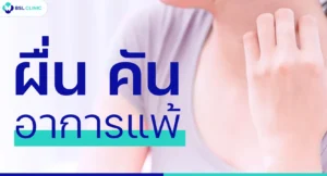 ผื่นคัน