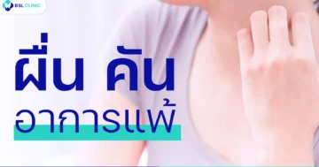 ผื่นคัน