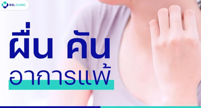 ผื่นคัน