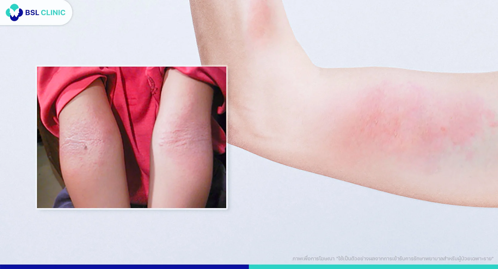 โรคภูมิแพ้ผิวหนัง